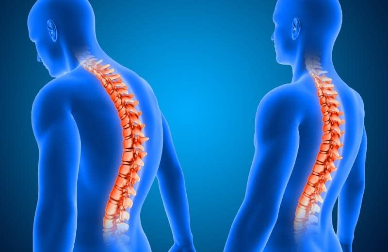 Diagnóstico y tratamiento de Escoliosis  ofrecido  por él Dr. Adrián Abrego - Especialista en Neurocirugía y Cirugía de Columna